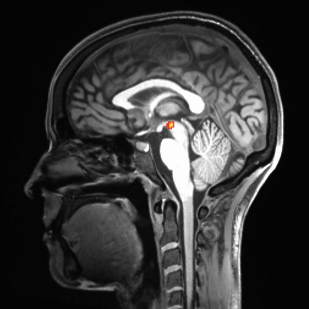 Black and white fMRI scan of Dessa's brain, with her head in profile, and a tiny red dot at the base of the brain